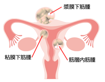子宮筋腫 | 婦人科の相談