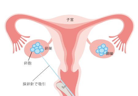 卵子をとり出します