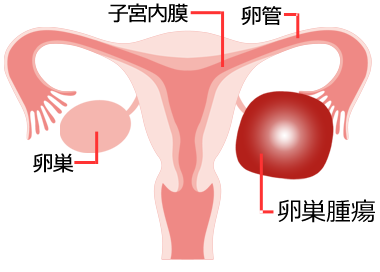 卵巣 腫瘍