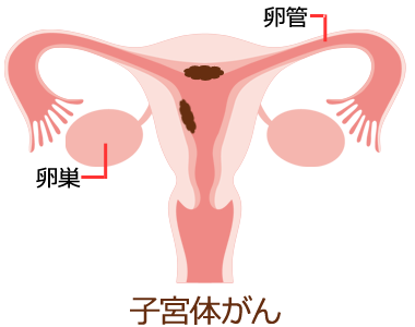 子宮がん | 婦人科の相談