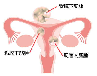 筋腫 子宮 子宮筋腫で多いといわれる症状のひとつ排尿障害の症状と改善方法とは？